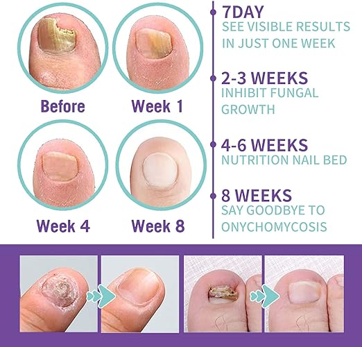 Anti-Schimmel Voeten & Nagelspray™ 👣 100ml