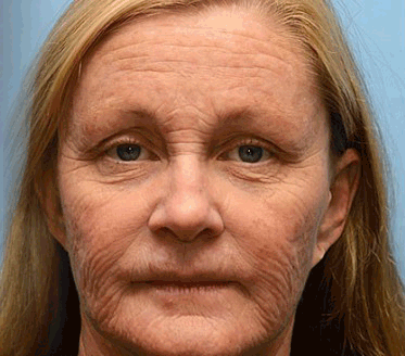 Anti-Rimpels™ | Botox Rimpelverwijdering Crème