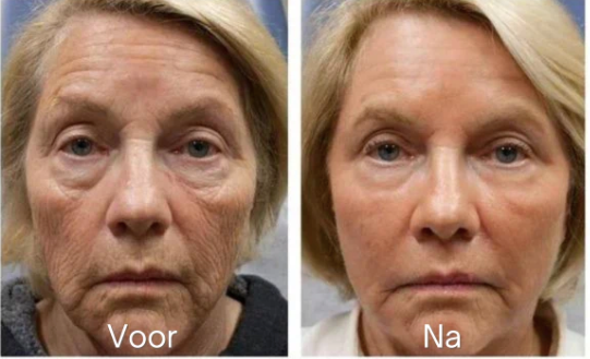 Anti-Rimpel Botox Gezichtsserum