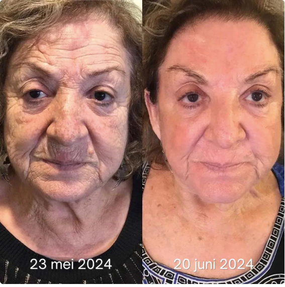 Anti-Rimpel Botox Gezichtsserum