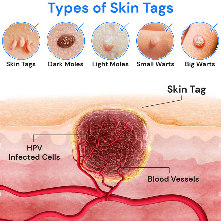 Wart-Remover™ - Wrat Verwijderaar 20ml