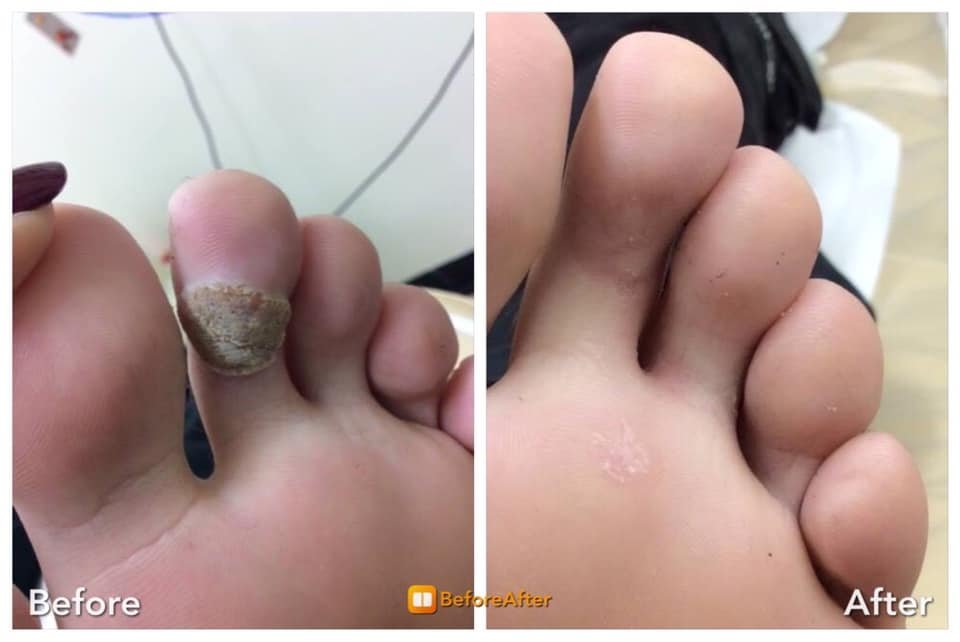 Wart-Remover™ - Wrat Verwijderaar 20ml