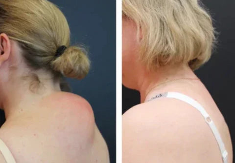 Micronaaldpleister®