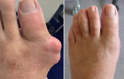 Micronaaldpleister®