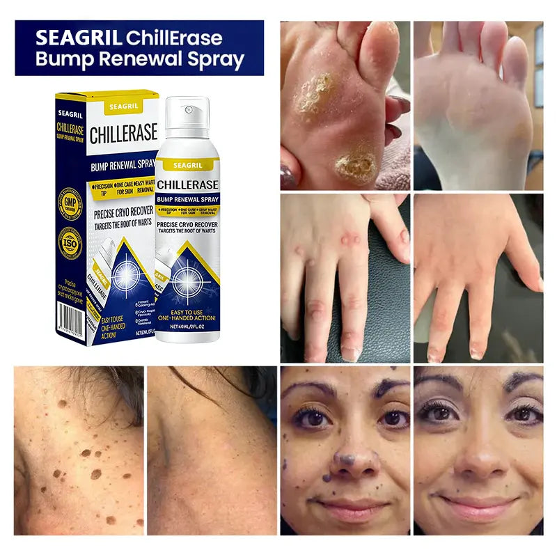 SEAGRIL™ ChillErase Spray tegen bultjes en huidoneffenheden